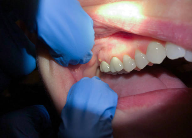 Best Emergency Treatment for Dental Infections or Abscesses in Quarryville, PA
