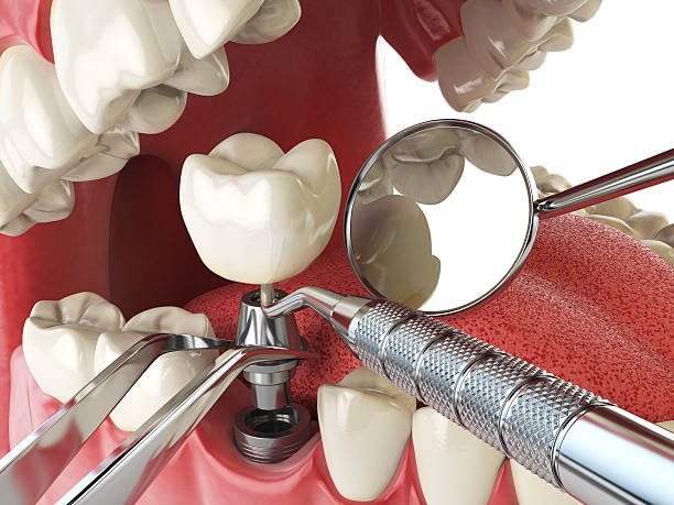 Best Urgent Care for Lost Fillings or Crowns in Quarryville, PA